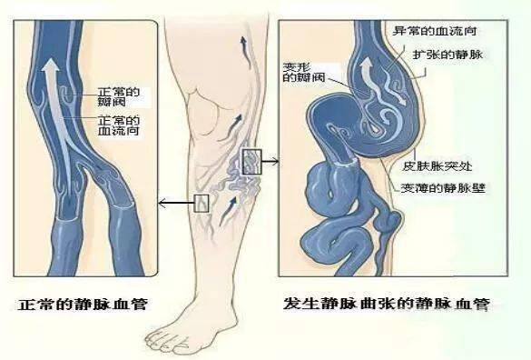 靜脈曲張最新治療方法,最新靜脈曲張治療方法的研究與探索